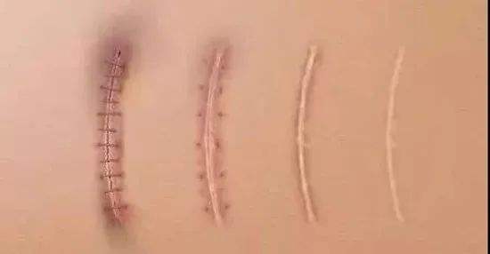疤痕